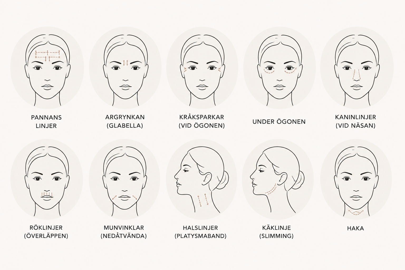 Illustration över vanliga behandlingsområden för botox